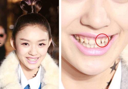 明星有假牙吗,他们真的有假牙吗？